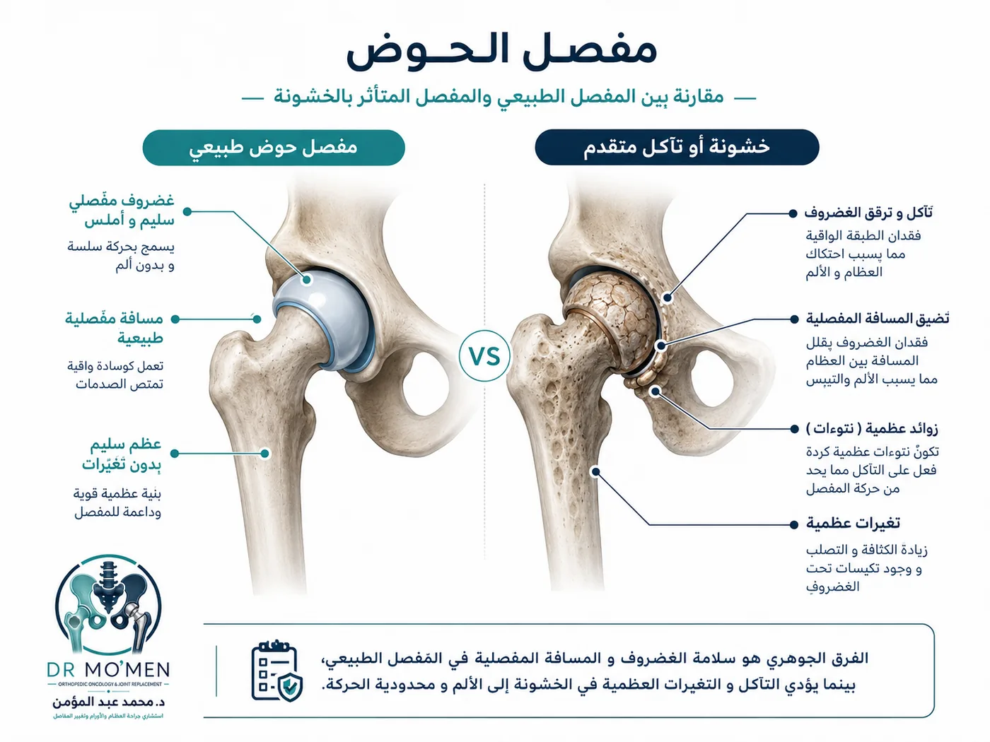الفرق بين مفصل الحوض الطبيعي وخشونة مفصل الفخذ قبل تغيير مفصل الحوض