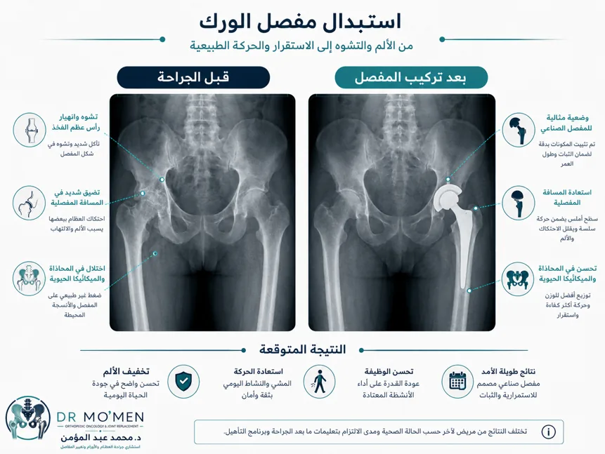 أشعة مفصل الحوض قبل وبعد تركيب مفصل صناعي للفخذ