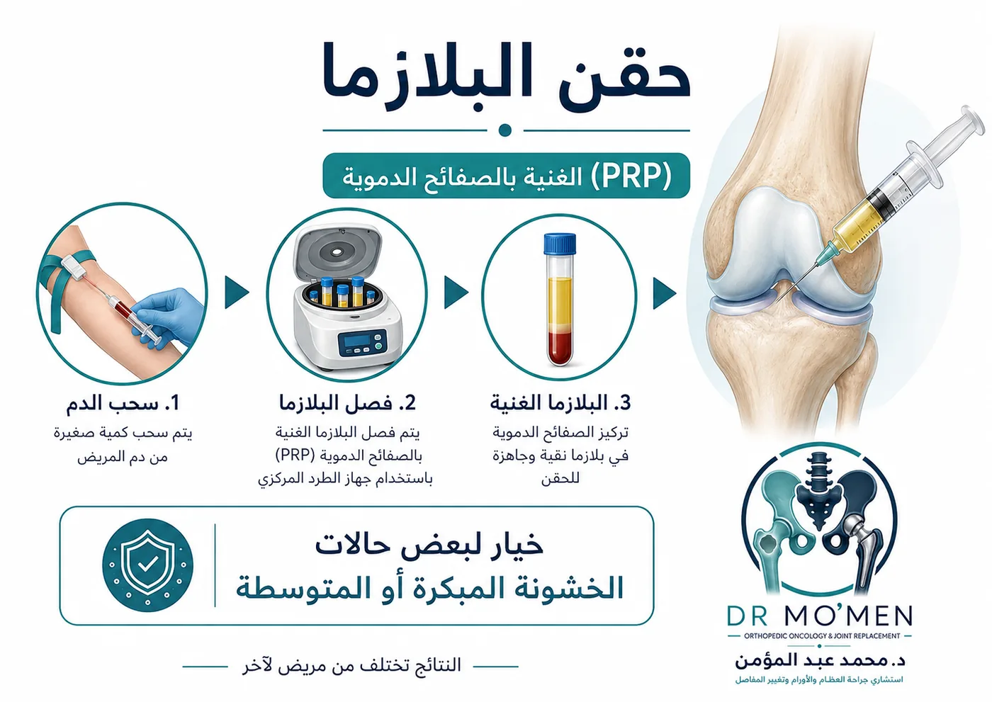 حقن البلازما للركبة في خشونة الركبة المبكرة والمتوسطة