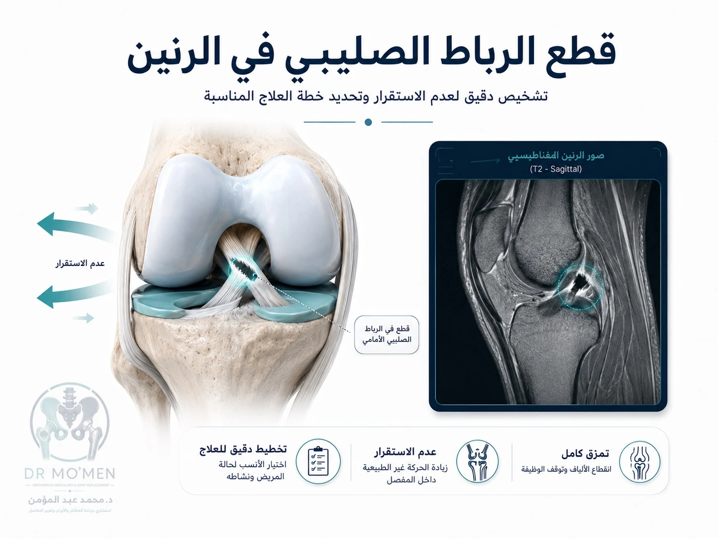 رسم طبي يوضح قطع الرباط الصليبي الأمامي وعدم ثبات الركبة في الرنين