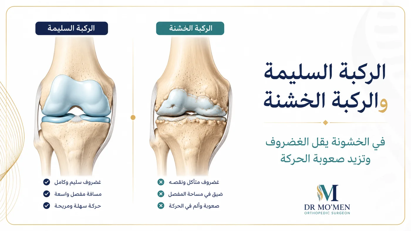 الفرق بين الركبة السليمة وخشونة الركبة وتآكل الغضروف
