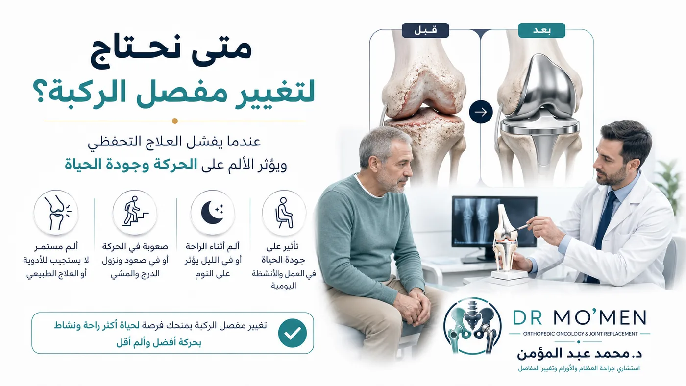 متى يحتاج مريض خشونة الركبة إلى تغيير مفصل الركبة في الخشونة المتقدمة