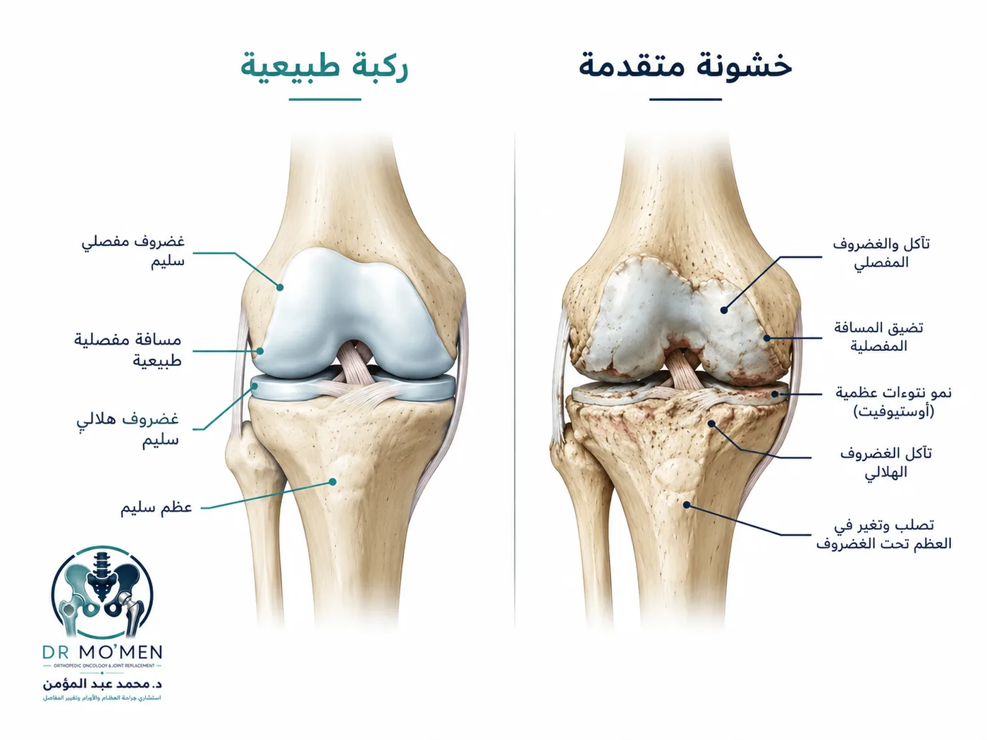 الفرق بين الركبة الطبيعية وخشونة الركبة المتقدمة قبل تغيير مفصل الركبة