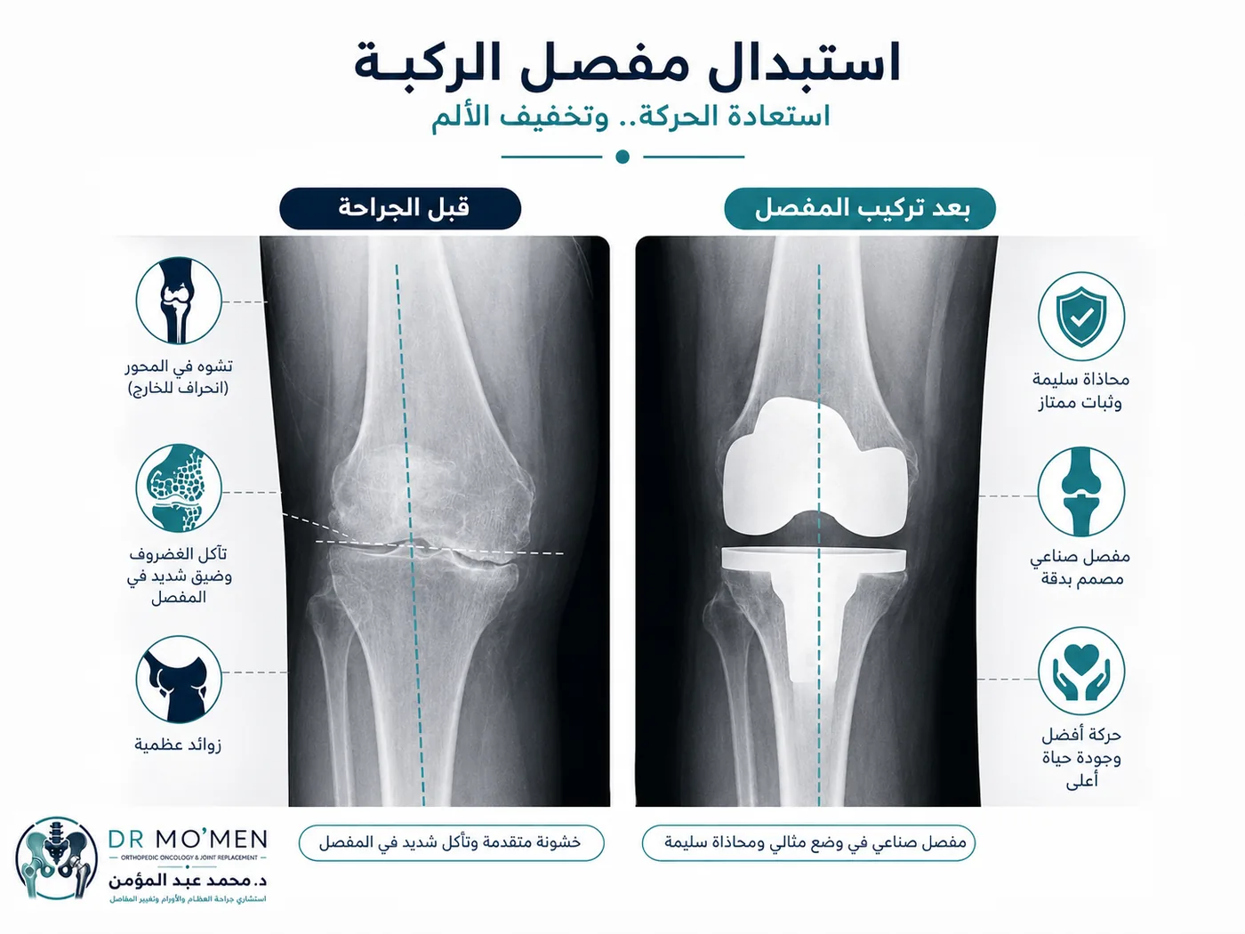 أشعة خشونة الركبة المتقدمة قبل وبعد تركيب مفصل صناعي للركبة