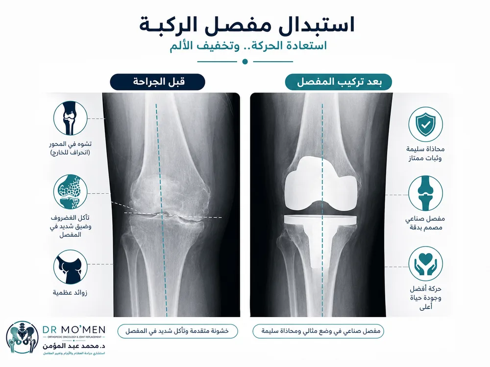 تقييم خشونة الركبة بالأشعة والفحص قبل قرار تغيير المفصل