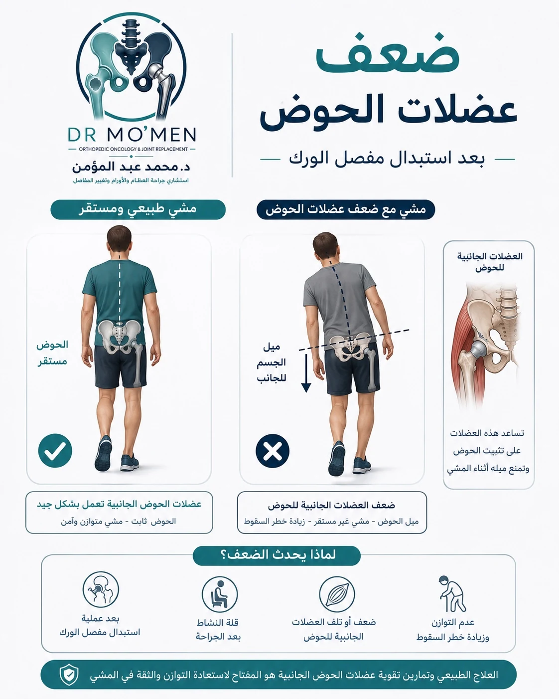 ضعف عضلات الحوض بعد تغيير مفصل الفخذ ودوره في ميل الجسم والعرج أثناء المشي