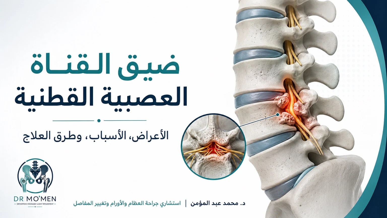 ضيق القناة العصبية القطنية والأعراض ومتى تحتاج لجراحة