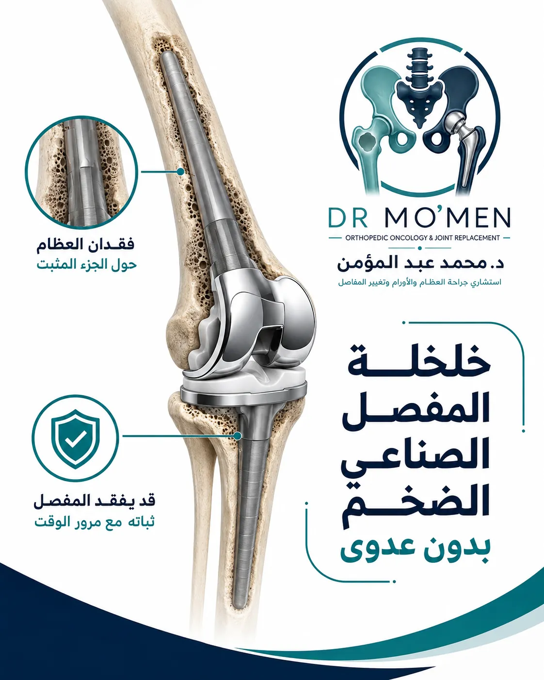 خلخلة المفصل الصناعي الضخم بدون عدوى مع فقدان العظام حول الجزء المثبت