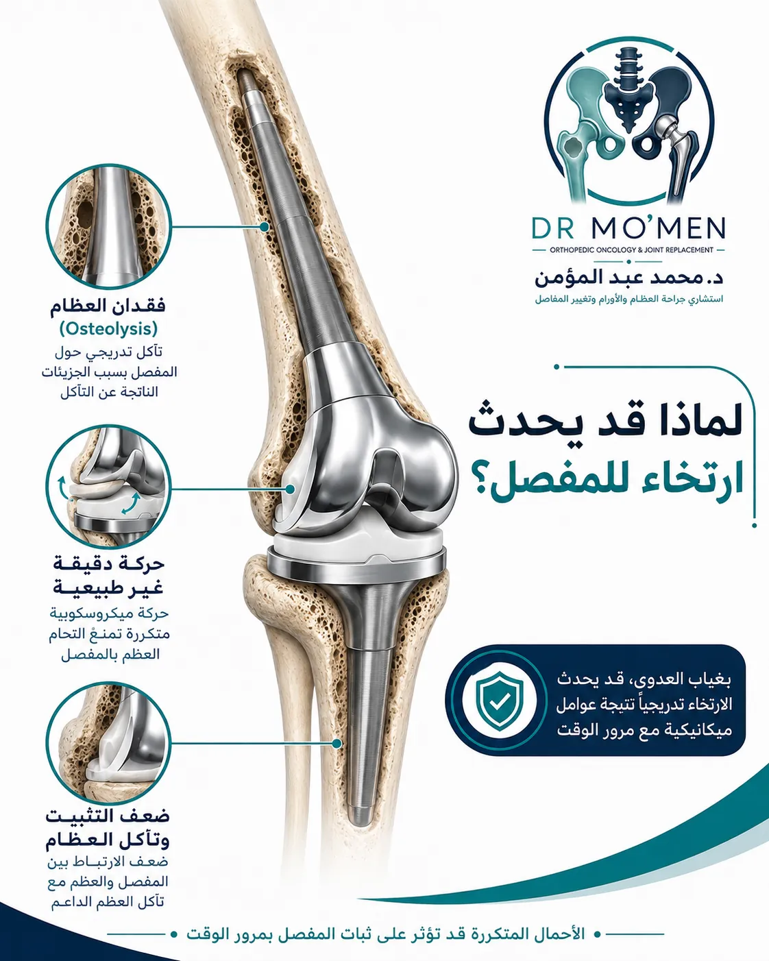 فقدان العظام والحركة الدقيقة حول الجزء المثبت من المفصل الصناعي الضخم