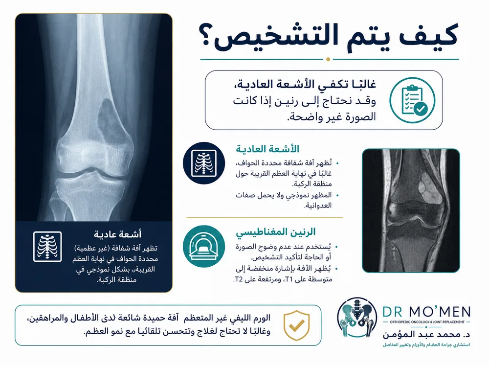 الورم الليفي غير المتعظم NOF عند الأطفال — صورة توضيحية داخل المقال رقم 3