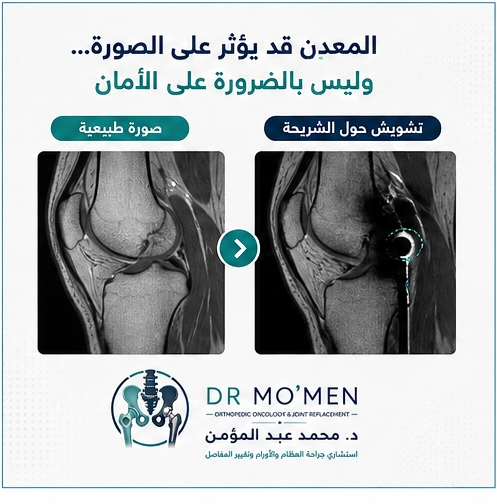 صورة تعليمية توضح أن وجود المعدن قد يسبب تشويشًا موضعيًا في MRI دون أن يعني ذلك تلقائيًا أن الفحص غير آمن