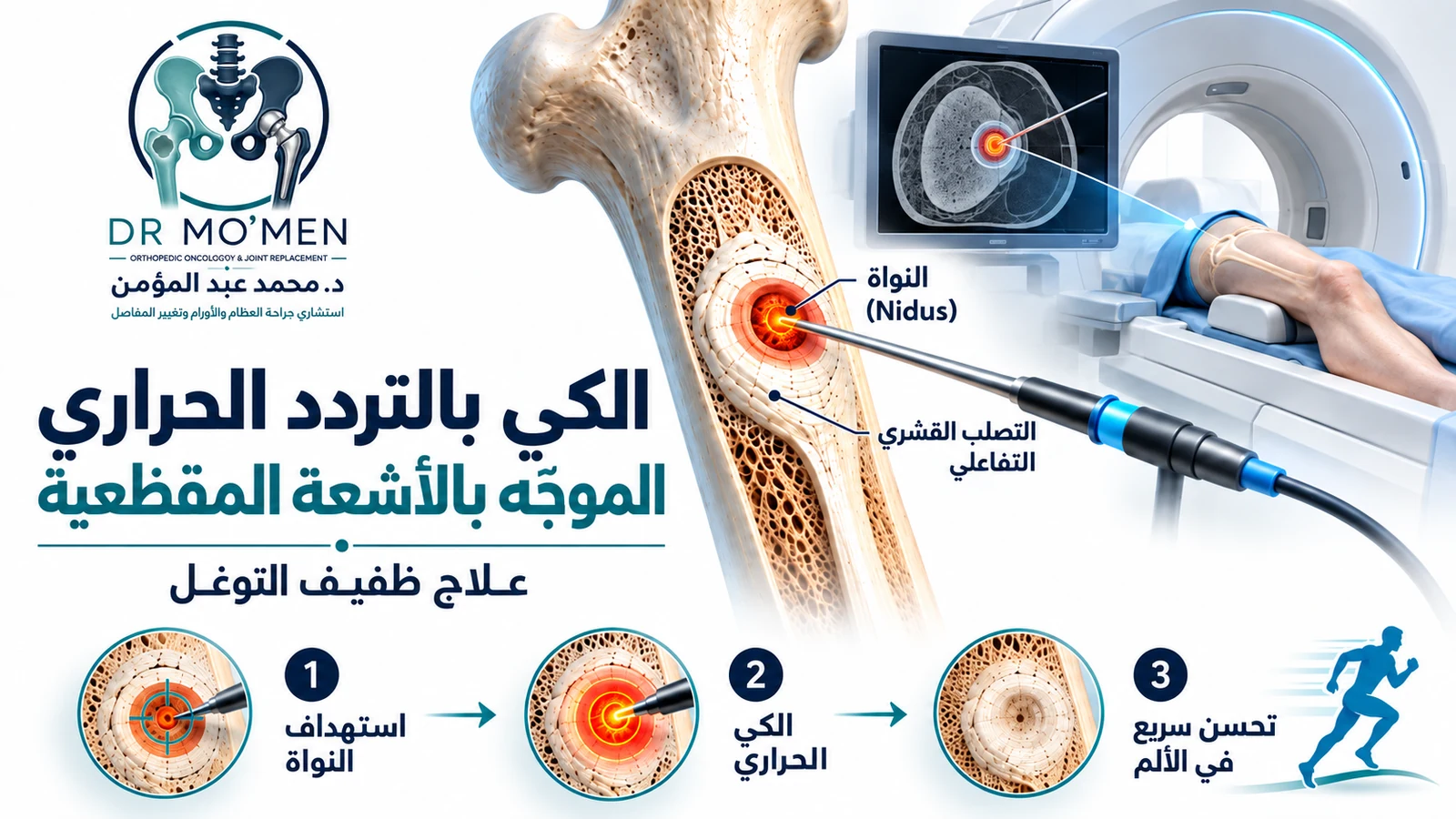 رسم طبي توضيحي للكي بالتردد الحراري الموجّه بالأشعة المقطعية مع استهداف نواة الورم العظمي العظماني.