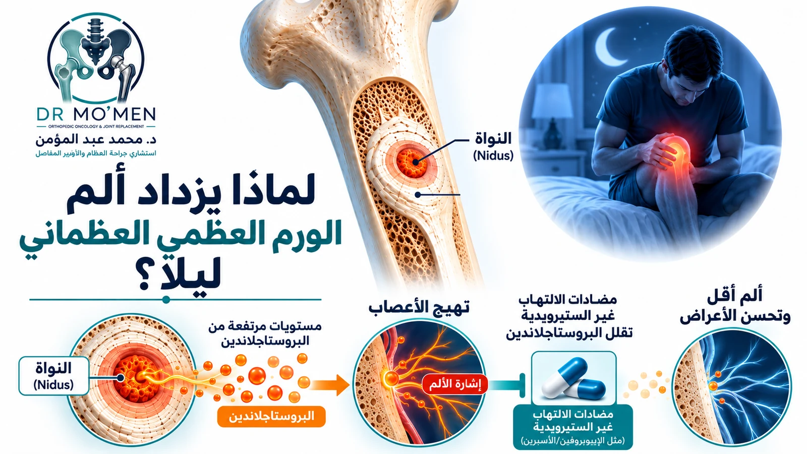مخطط طبي يوضح دور البروستاجلاندين في ألم الورم العظمي العظماني وكيف تقلل مضادات الالتهاب غير الستيرويدية هذا المسار.