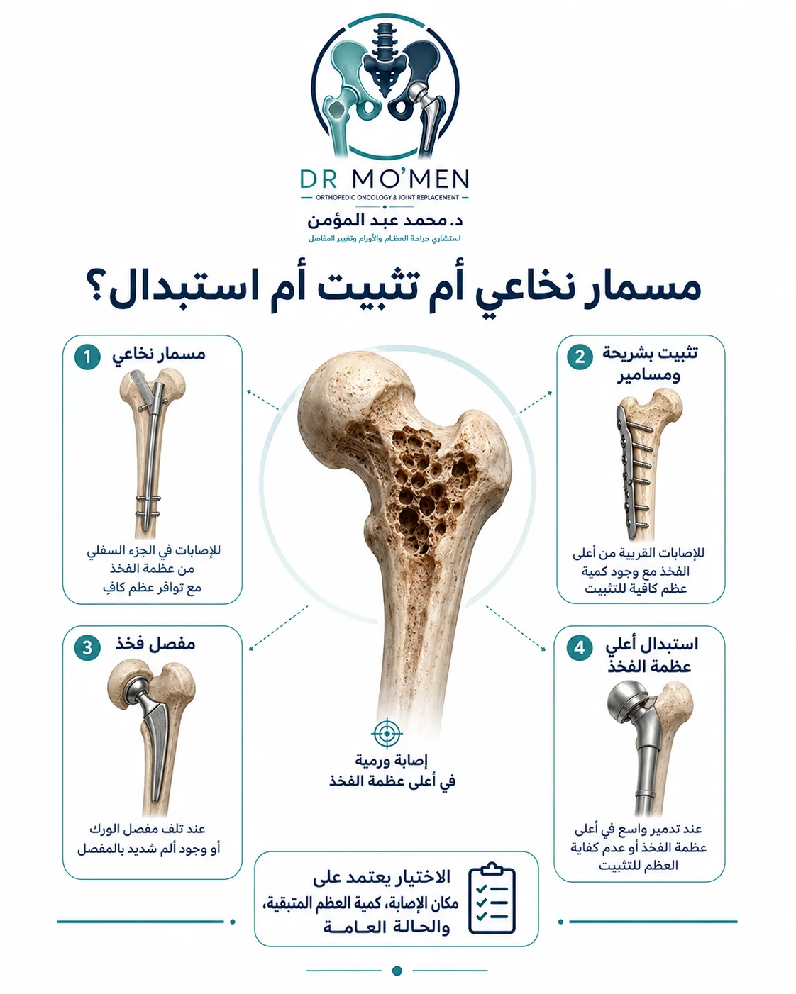 خيارات تثبيت وإعادة بناء عظمة الفخذ المصابة بانتقالات سرطانية حسب مكان الآفة والعظام المتبقية