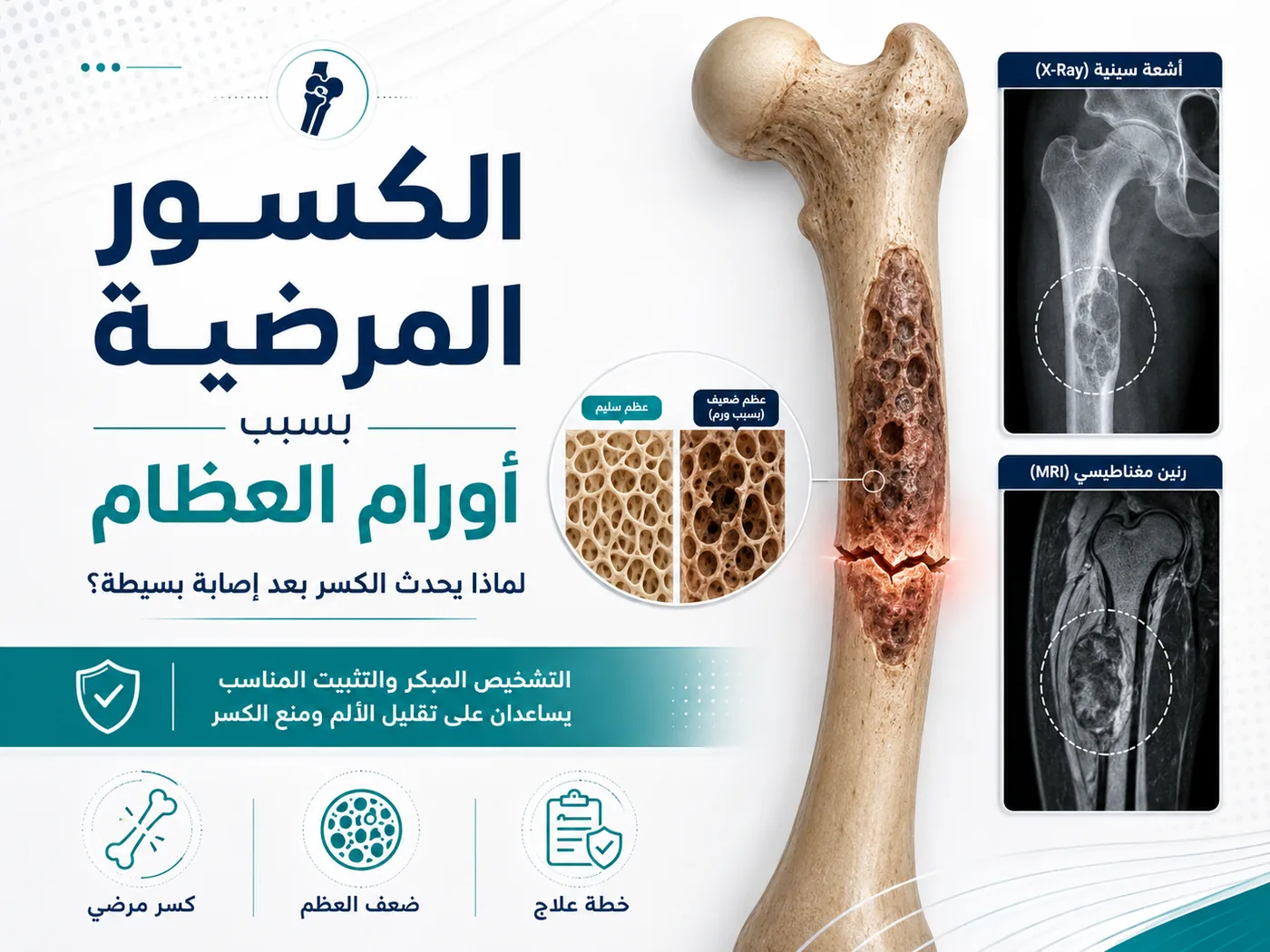 الكسور المرضية بسبب أورام العظام والنقائل العظمية وتثبيت العظام الضعيفة
