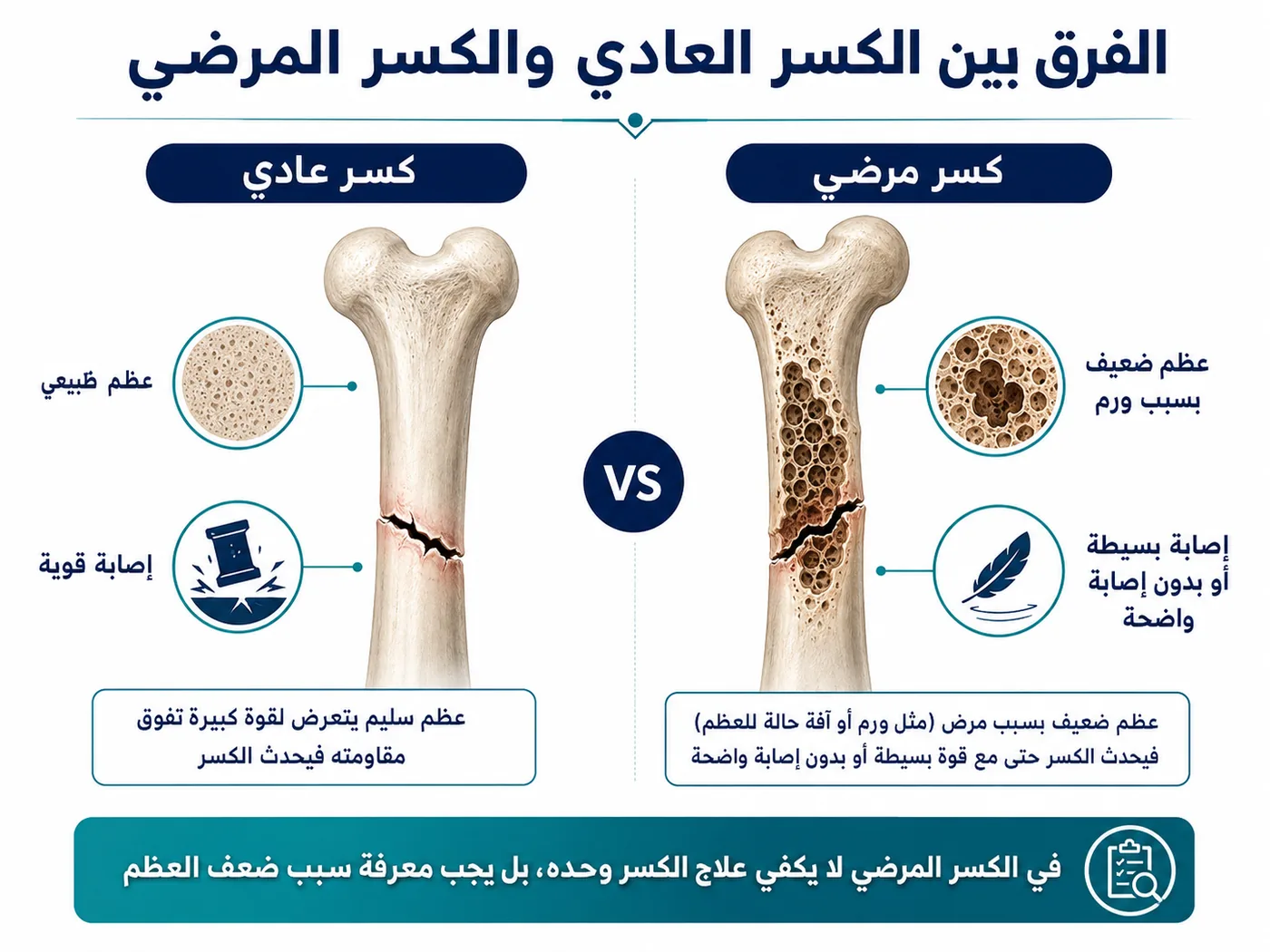 الفرق بين الكسر العادي والكسر المرضي بسبب ضعف العظام أو وجود ورم عظمي