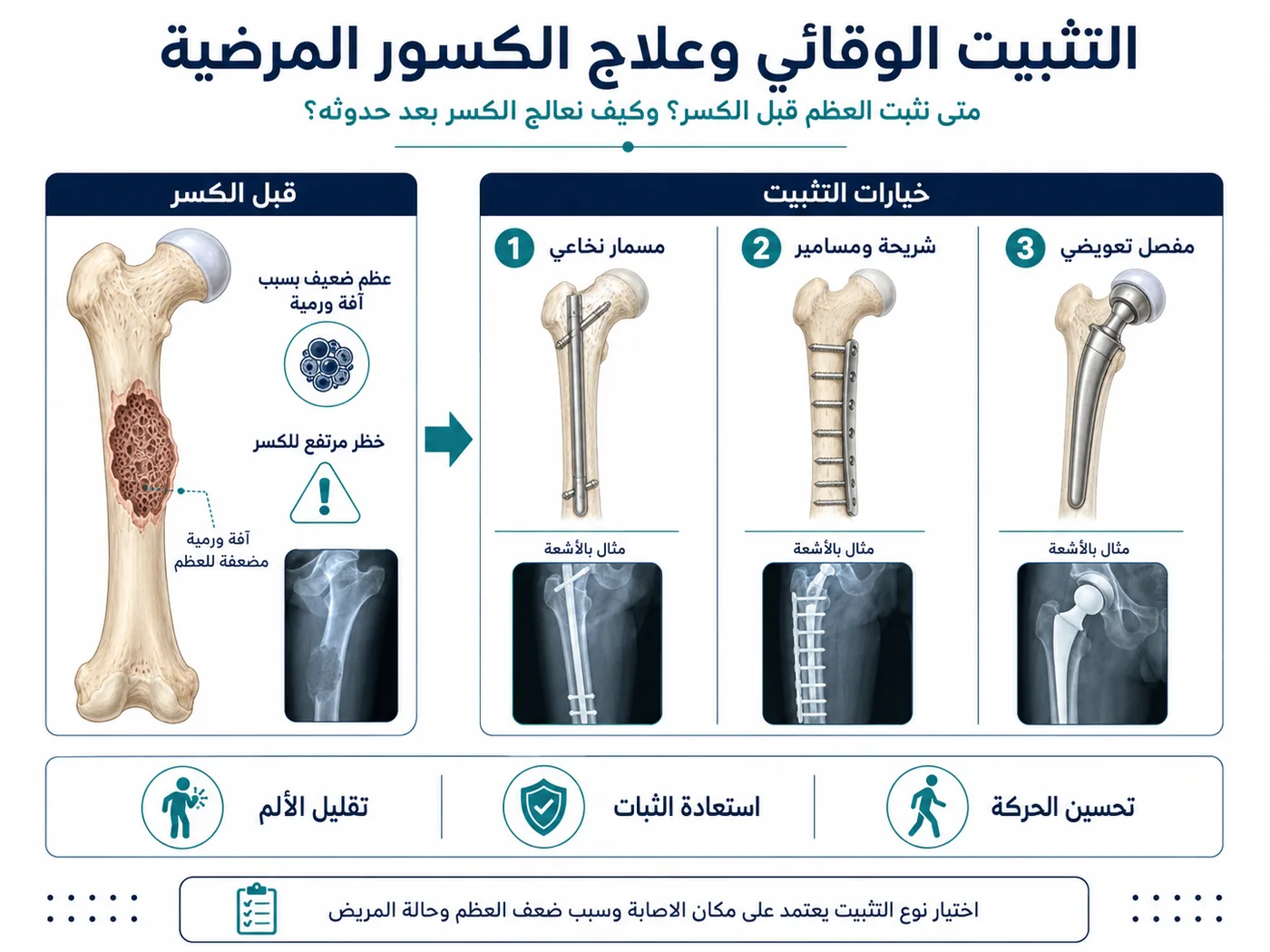 التثبيت الوقائي للكسور المرضية باستخدام مسمار نخاعي أو شريحة ومسامير