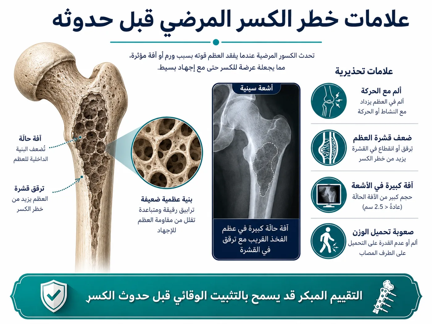 علامات خطر الكسر المرضي في عظمة ضعيفة بسبب ورم أو نقائل عظمية