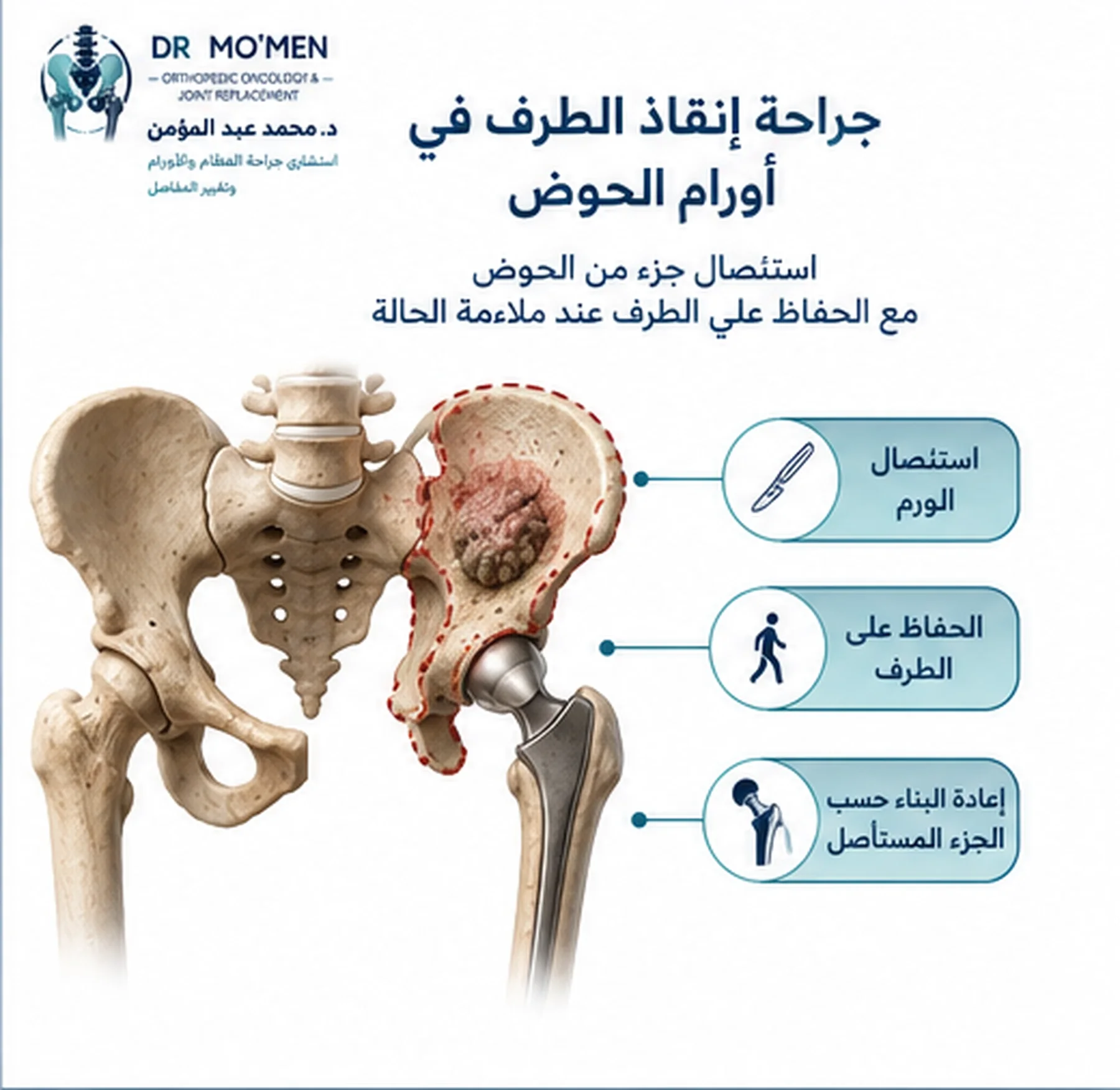 رسم طبي يوضح مفهوم استئصال جزء من الحوض مع الحفاظ على الطرف السفلي في جراحة أورام الحوض