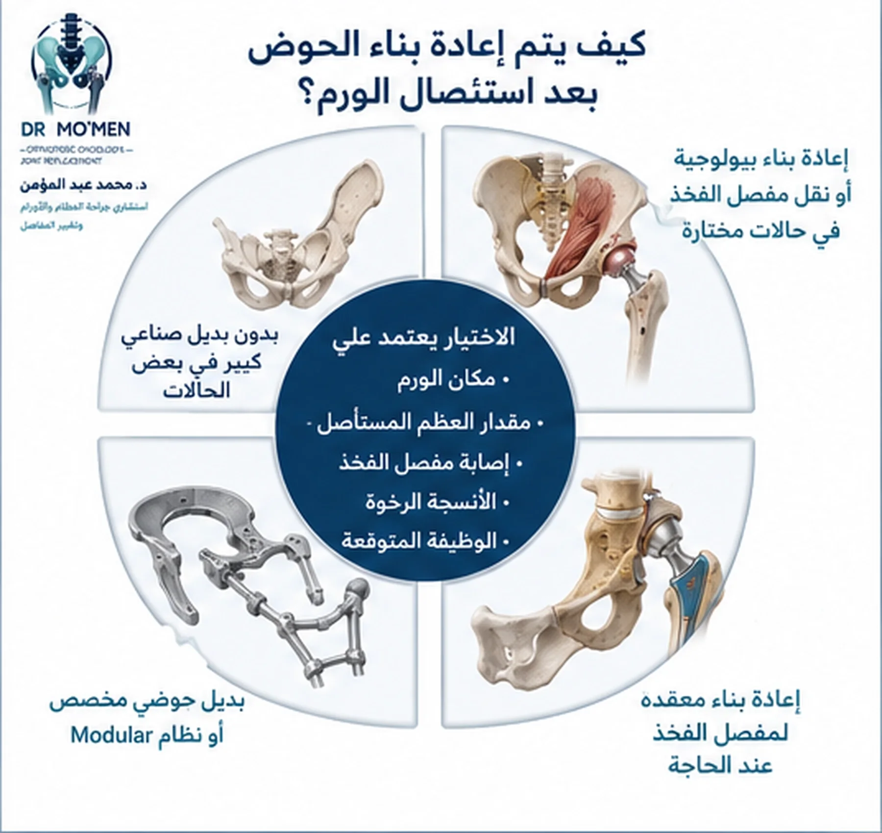 إنفوجراف يوضح خيارات إعادة بناء الحوض بعد استئصال ورم عظمي