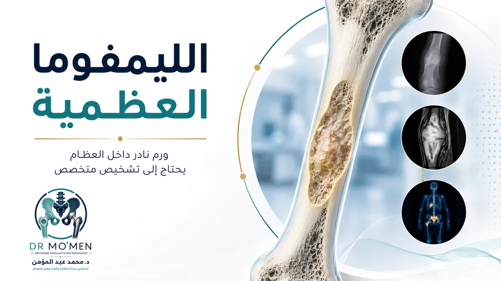 الليمفوما العظمية الأولية — صورة توضيحية داخل المقال رقم 1