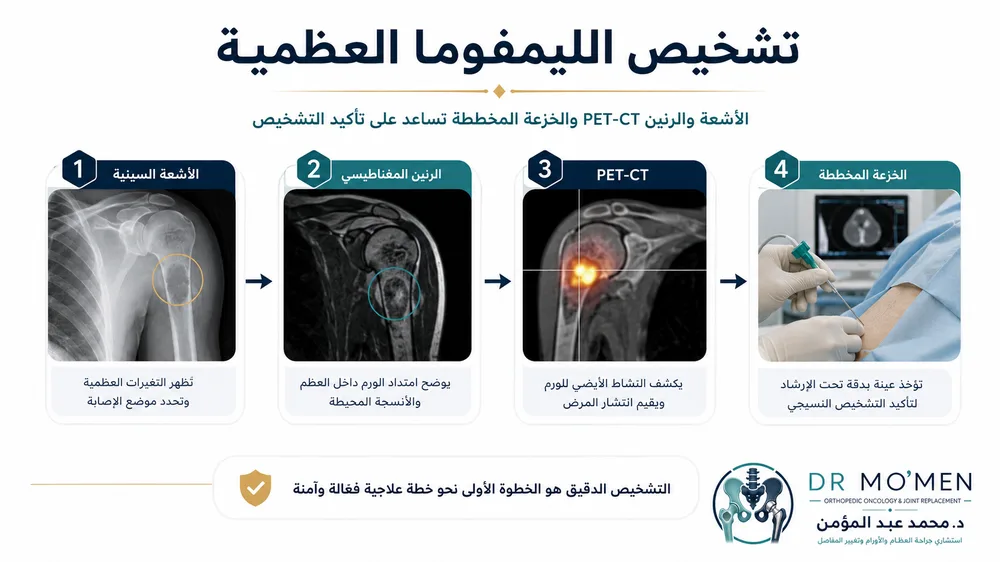 الليمفوما العظمية الأولية — صورة توضيحية داخل المقال رقم 3