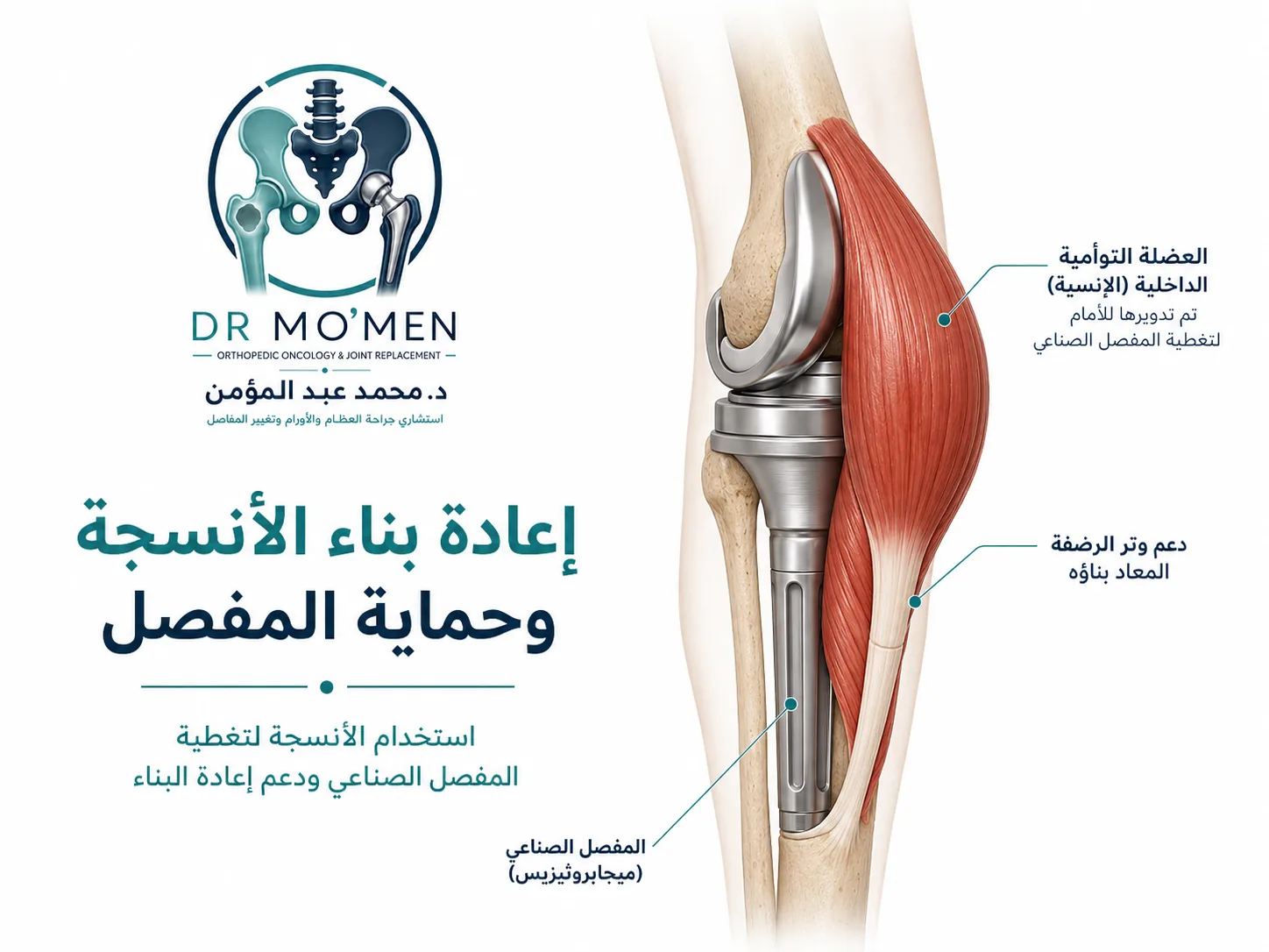 استخدام العضلة التوأمية الداخلية لتغطية المفصل الصناعي ودعم إعادة بناء الأنسجة