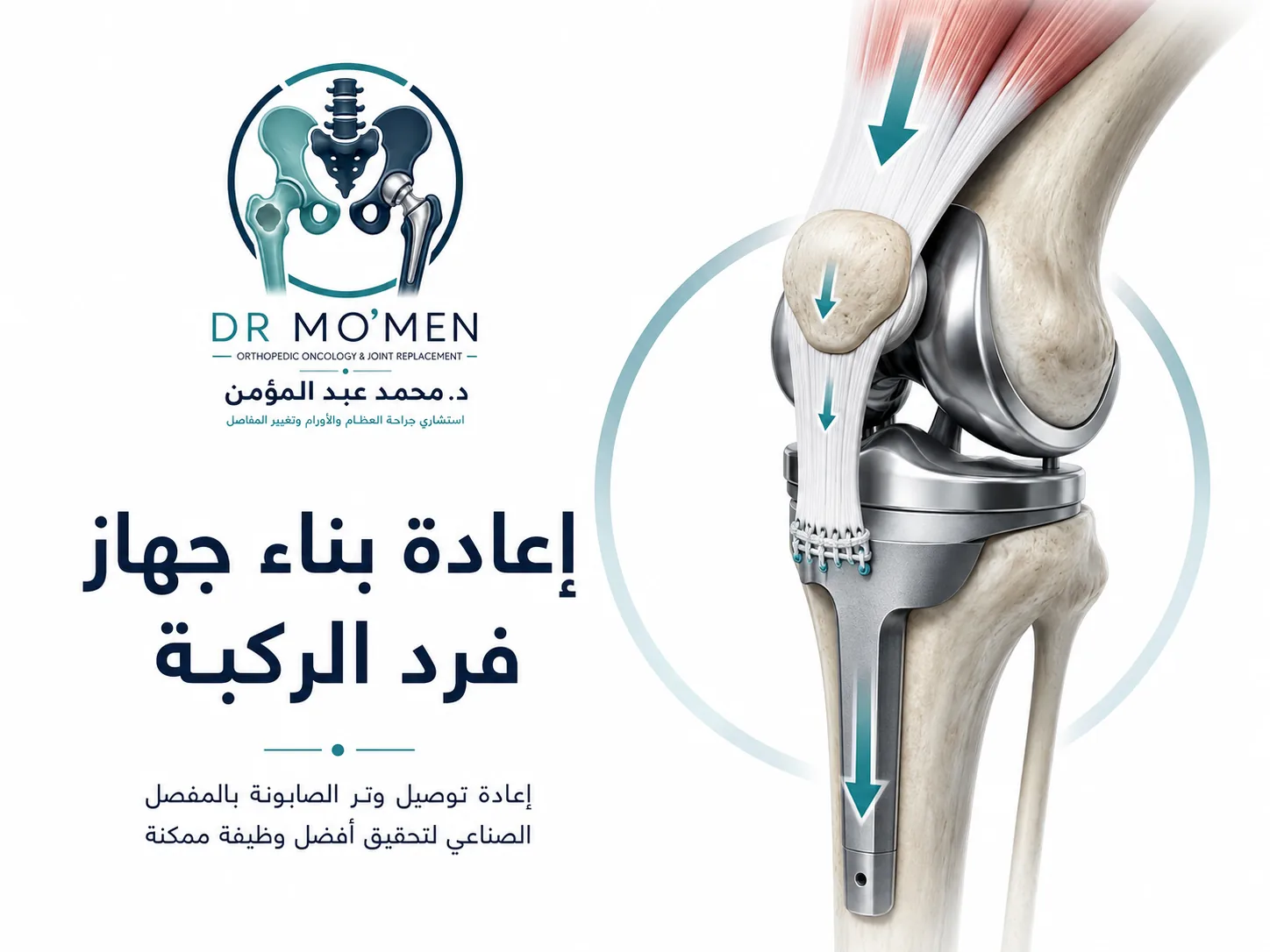 إعادة بناء وتر الصابونة وجهاز فرد الركبة بعد استئصال ورم أعلى عظمة الساق