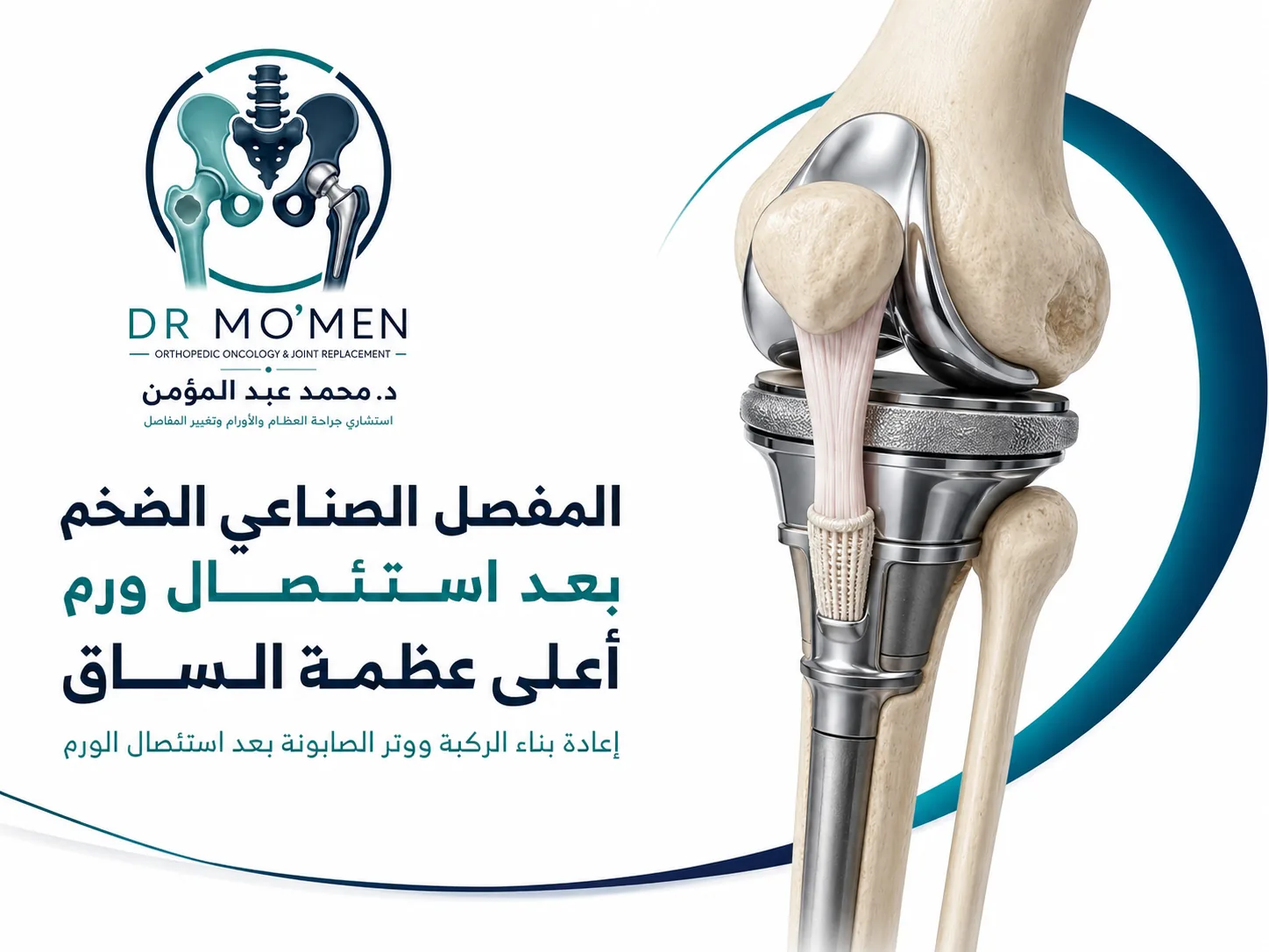 المفصل الصناعي الضخم لأعلى عظمة الساق بعد استئصال ورم العظام وإعادة بناء وتر الصابونة