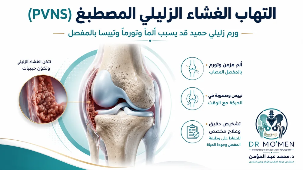 ورم الغشاء الزليلي PVNS / TGCT — صورة توضيحية داخل المقال رقم 1