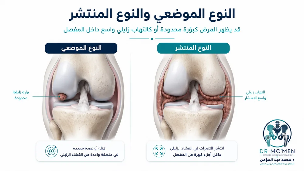 ورم الغشاء الزليلي PVNS / TGCT — صورة توضيحية داخل المقال رقم 2