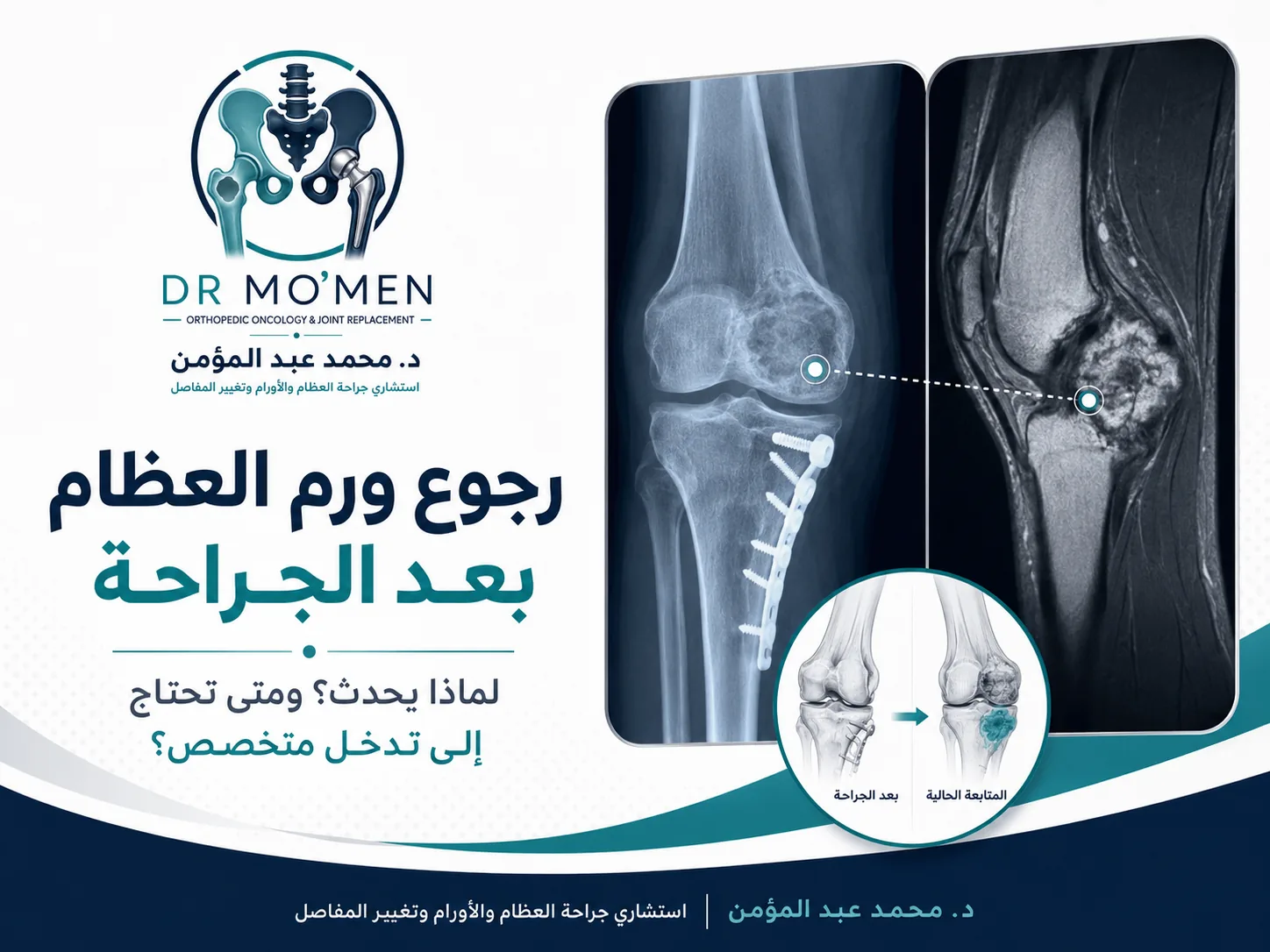 رجوع ورم العظام بعد الجراحة وتقييم الورم العظمي المتكرر بالأشعة والرنين