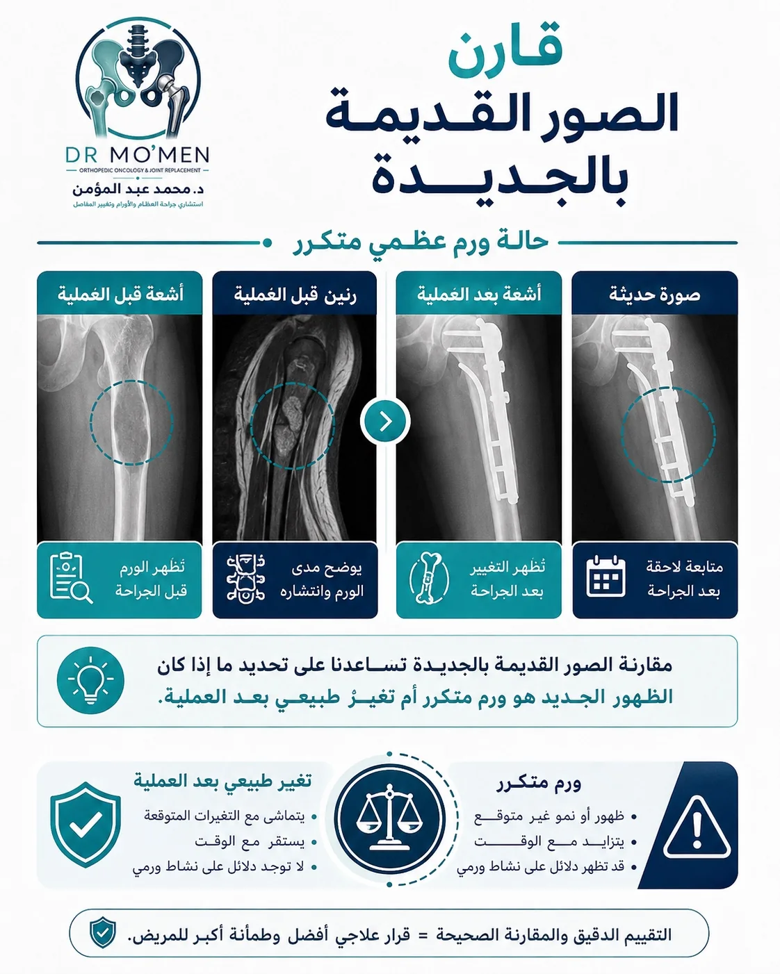 أهمية مقارنة الأشعة والرنين القديم والجديد عند تقييم ارتجاع ورم العظام
