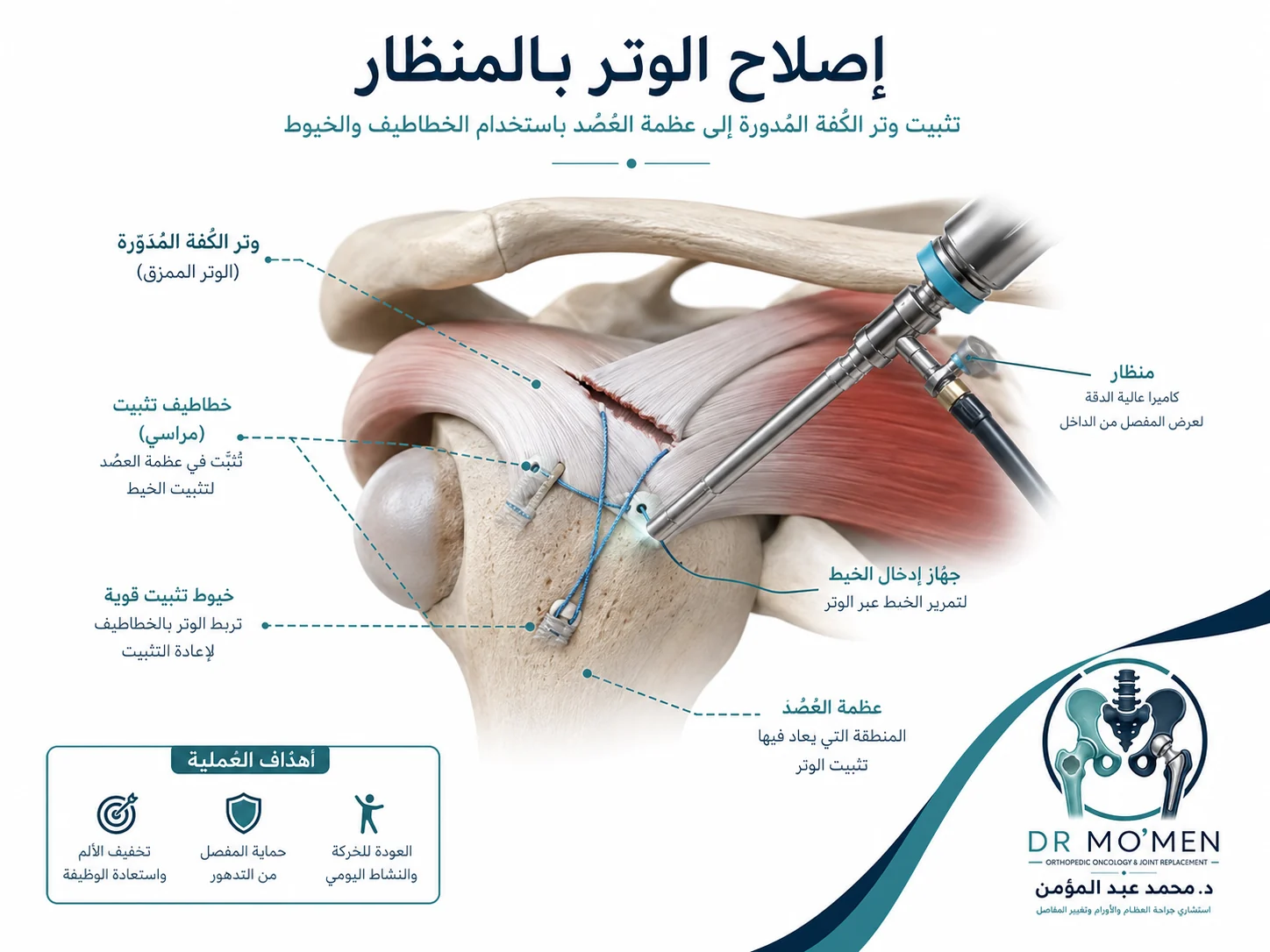 رسم طبي ثلاثي الأبعاد يوضح إصلاح تمزق أوتار الكتف بالمنظار باستخدام الخطاطيف والخيوط الجراحية.
