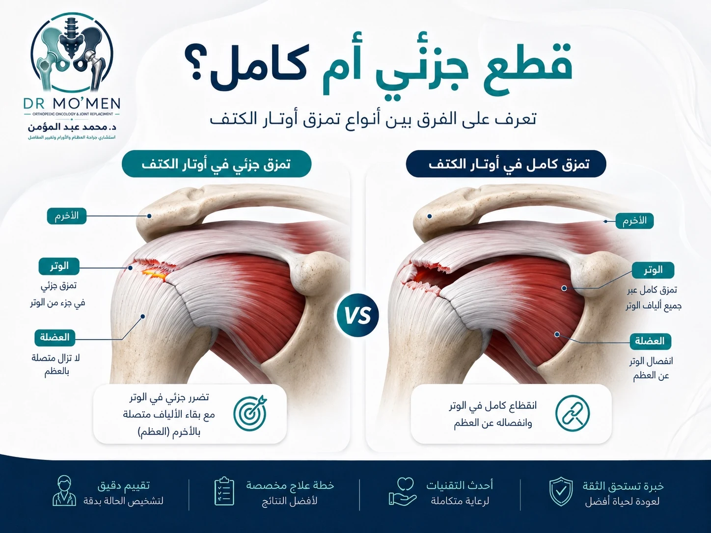 رسم طبي يوضح الفرق بين القطع الجزئي والقطع الكامل في أوتار الكتف