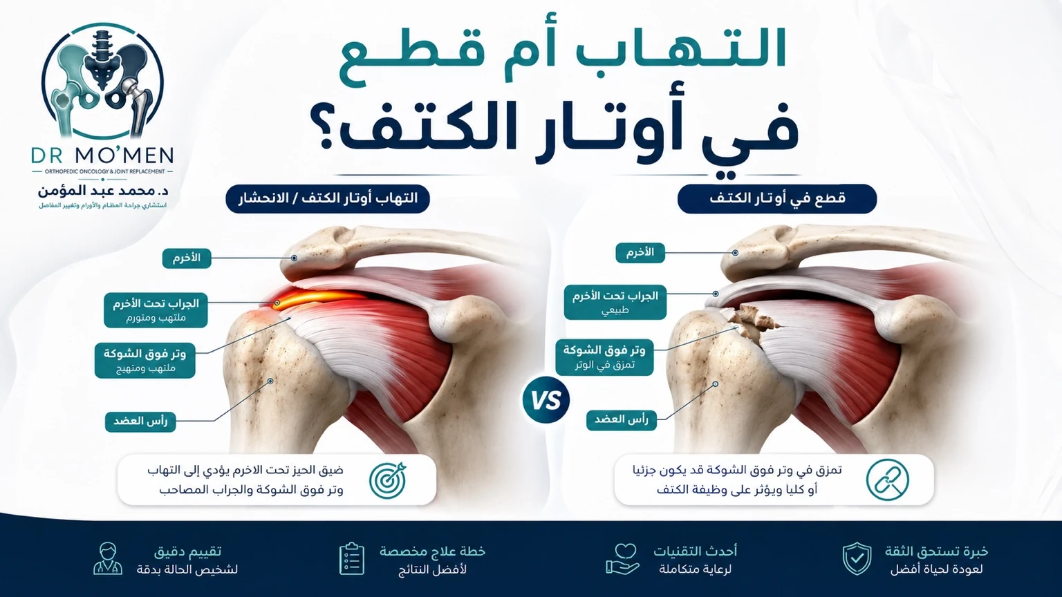 رسم طبي يوضح الفرق بين التهاب أوتار الكتف وقطع أوتار الكفة المدورة