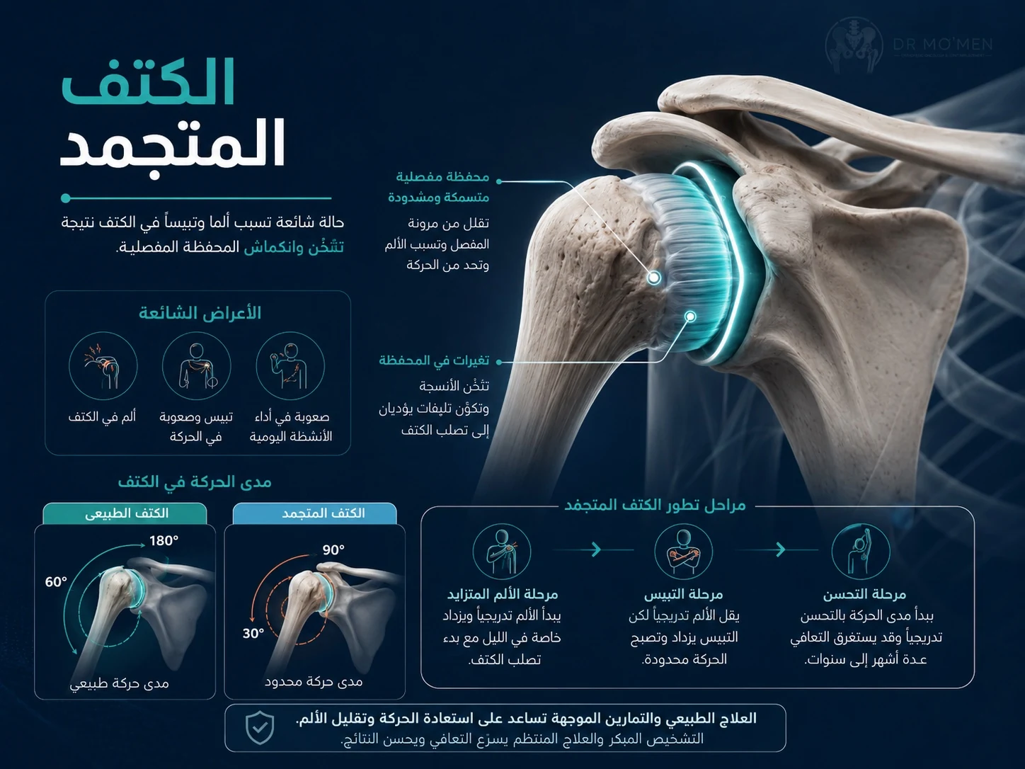 رسم طبي يوضح الكتف المتجمد وتيبس كبسولة مفصل الكتف