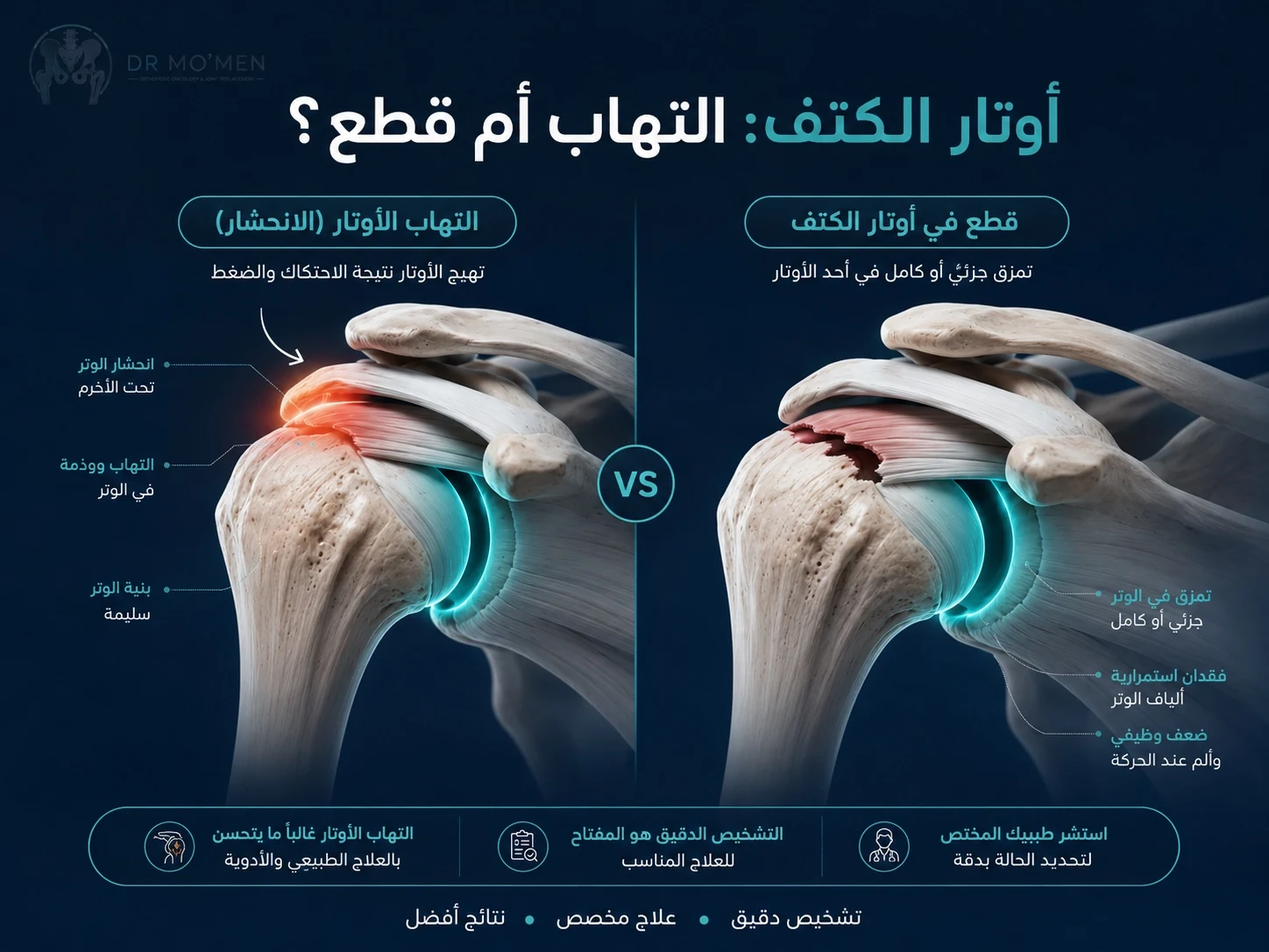 إنفوجرافيك يوضح التهاب وقطع أوتار الكتف والكفة المدورة