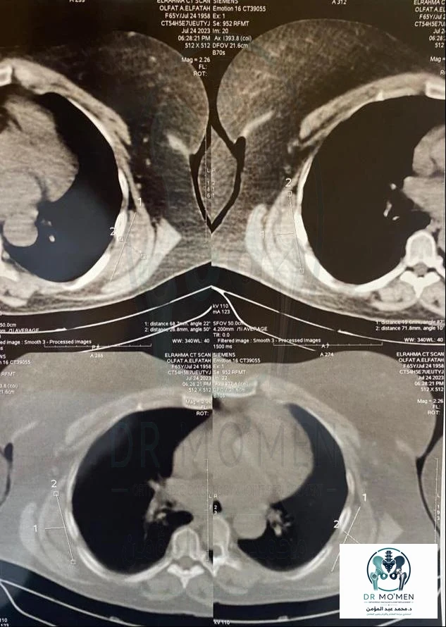 CT scan showing a deep infrascapular soft-tissue mass adjacent to the posterior chest wall, compatible with the typical location of elastofibroma dorsi.