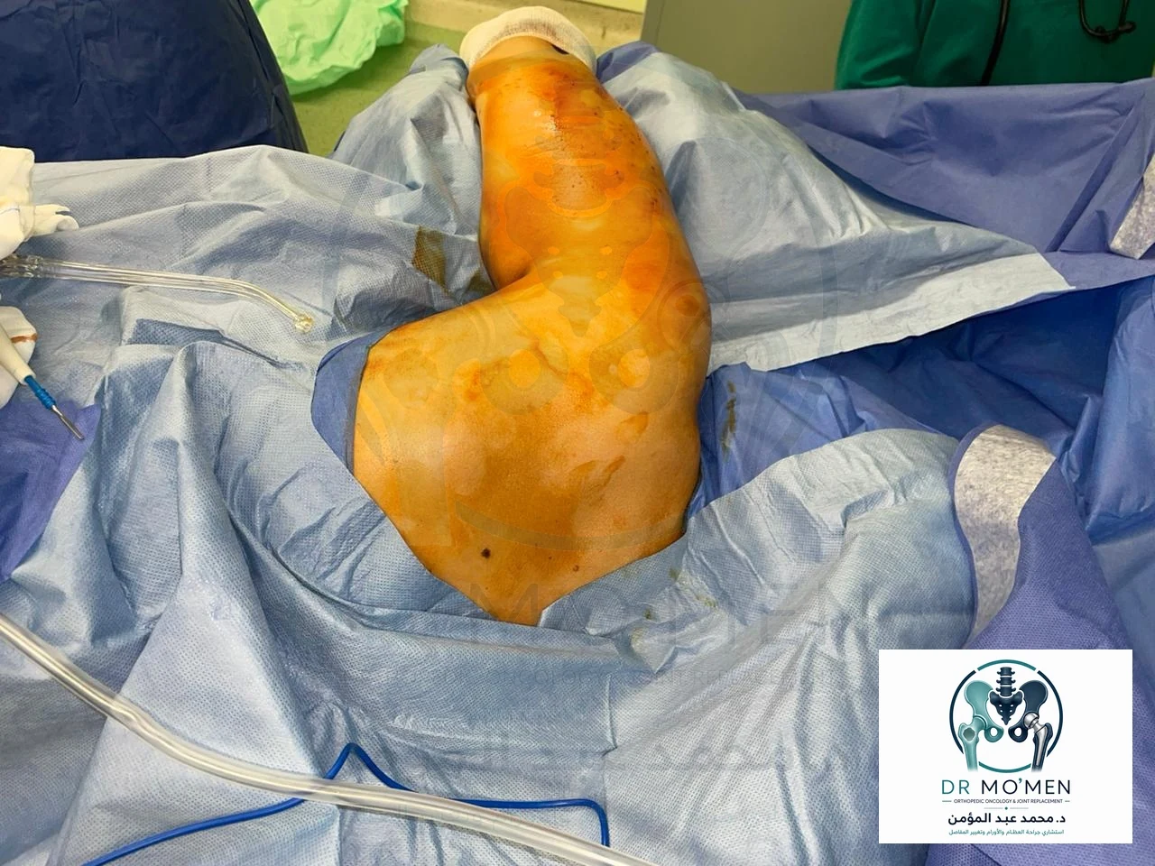 Operative positioning and sterile preparation of the shoulder and scapular region before surgical excision.