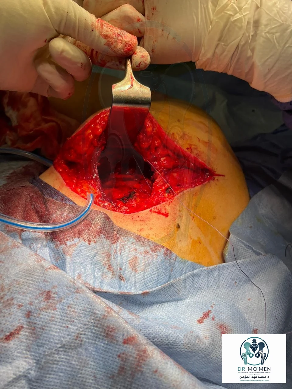 Intraoperative exposure of the deep infrascapular surgical field during excision of the elastofibroma dorsi.