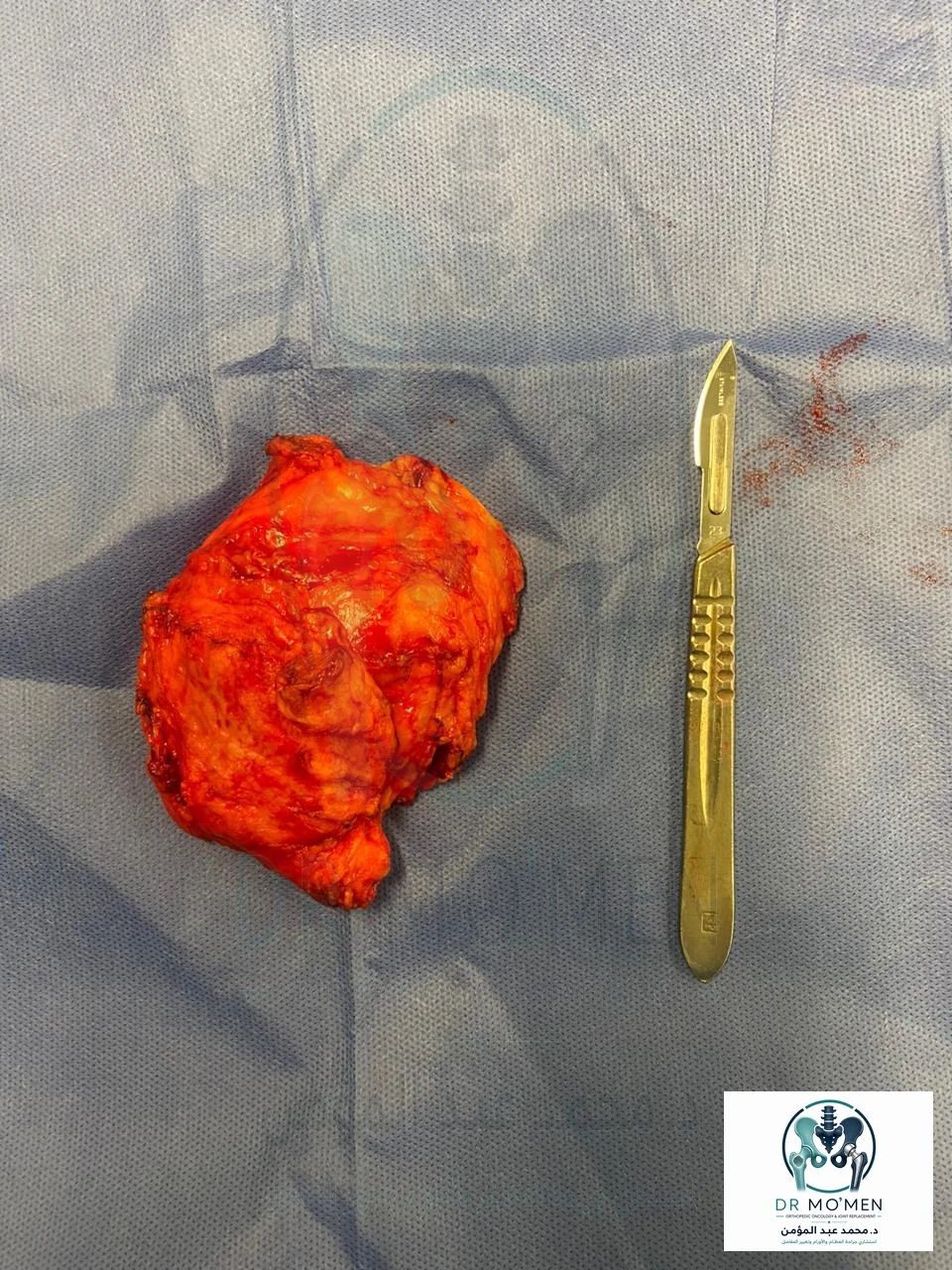 Excised elastofibroma dorsi specimen displayed next to a surgical scalpel for approximate scale.