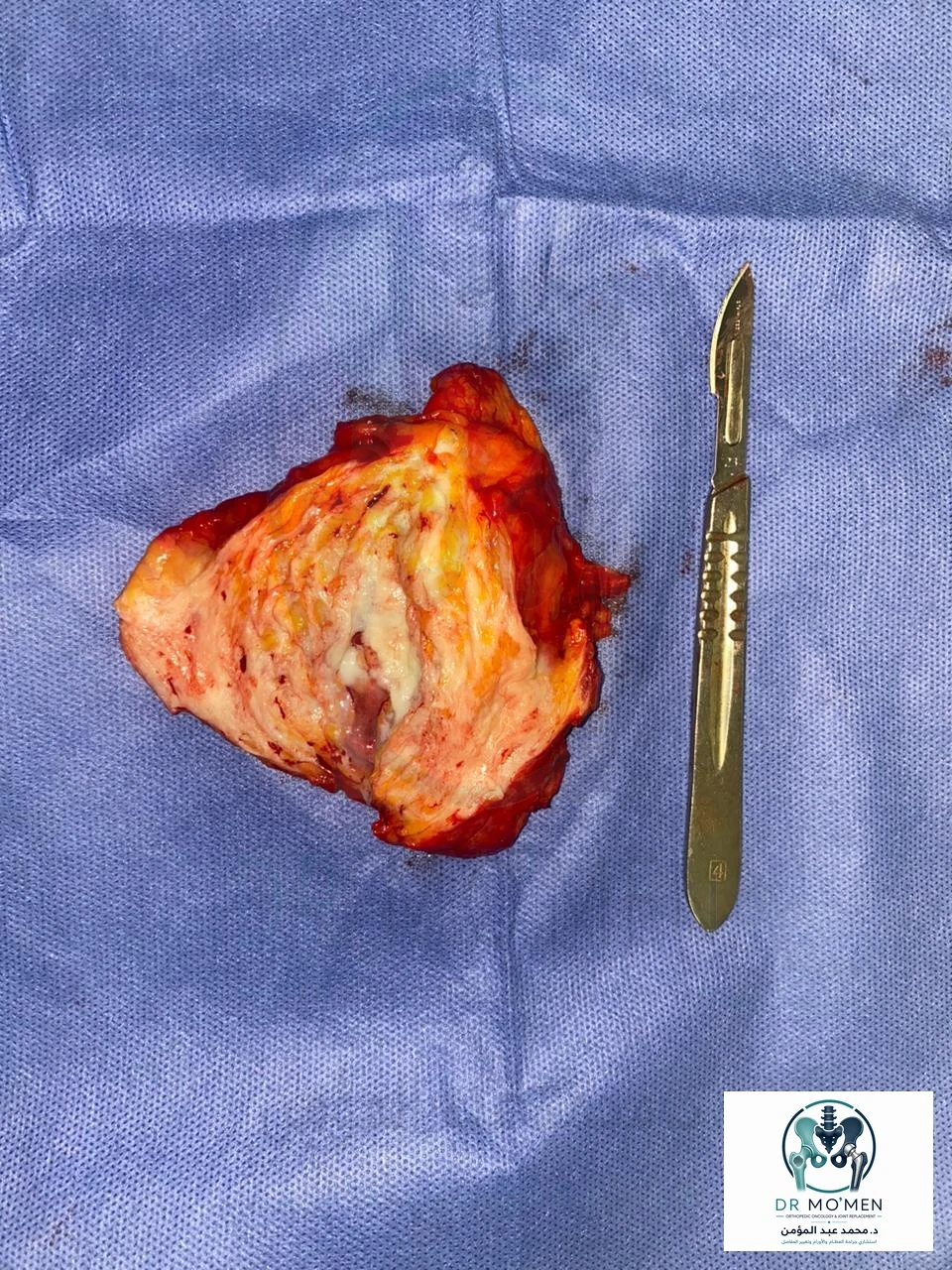 Cut surface of the excised lesion showing the characteristic heterogeneous fibrofatty gross appearance.