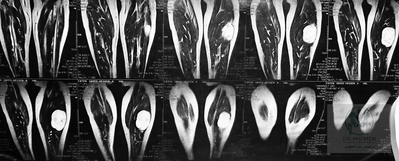 Second coronal MRI view demonstrating the lesion extent without bone involvement.