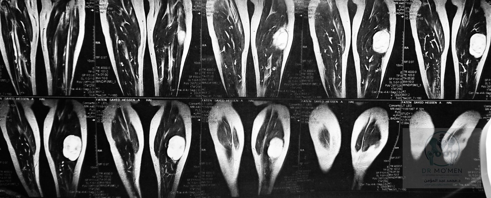 Second coronal MRI view demonstrating the lesion extent without bone involvement.