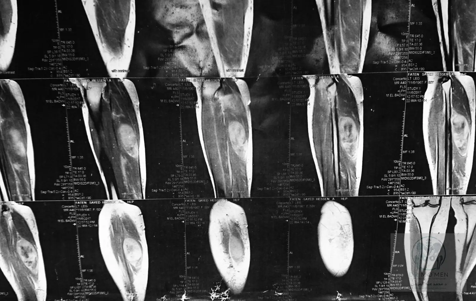 Longitudinal MRI view showing the ovoid lesion within the posterior calf compartment.