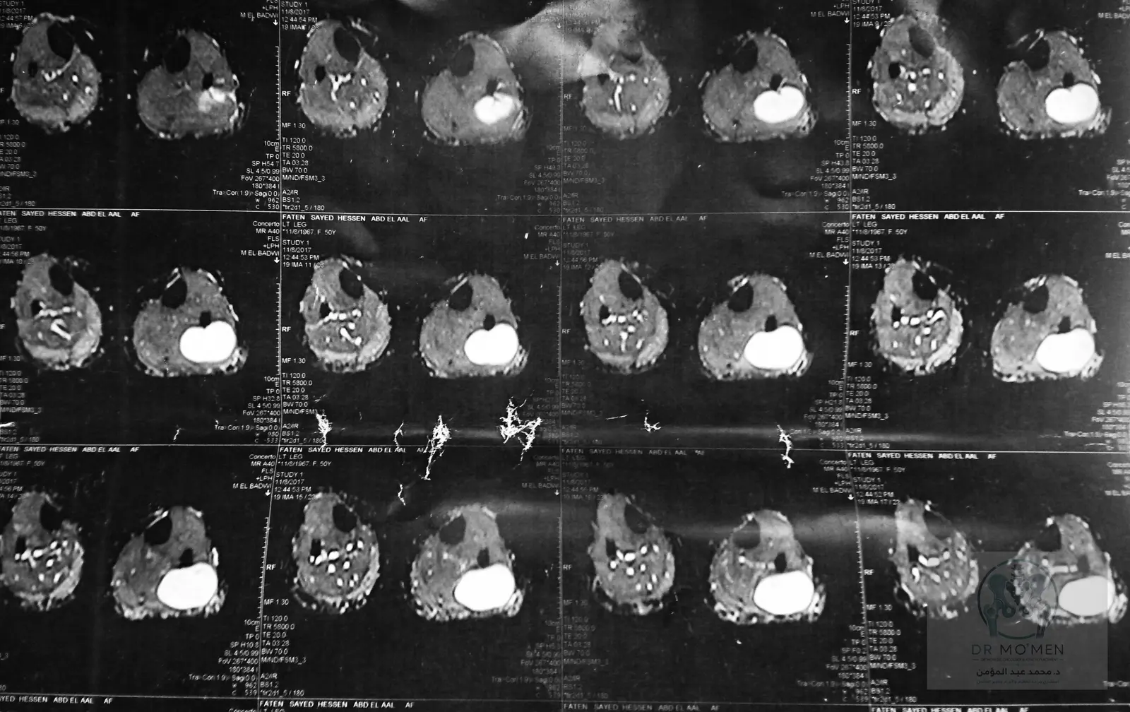 Axial MRI showing the mass and its relationship to the surrounding compartment.