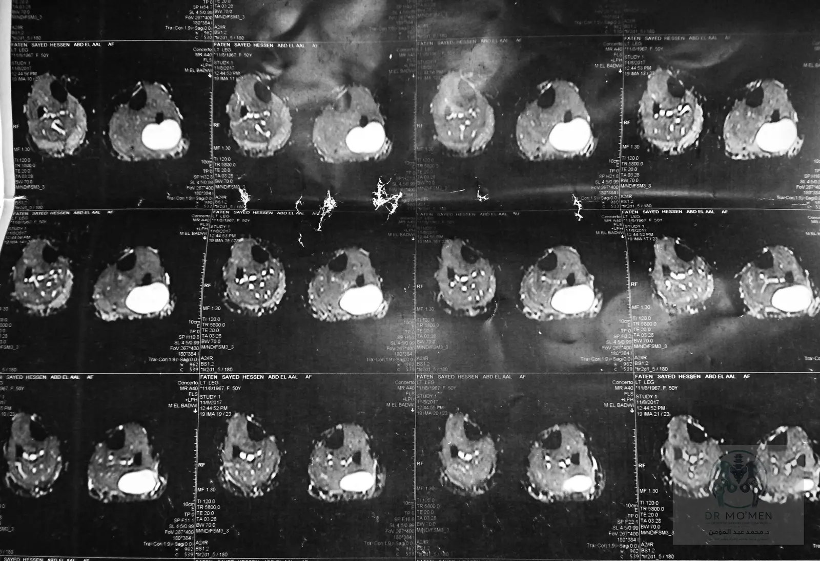 Additional axial MRI demonstrating the sharply defined lesion margin.