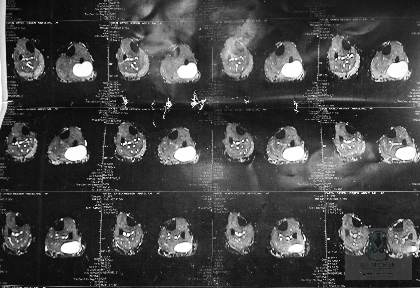 Additional axial MRI demonstrating the sharply defined lesion margin.