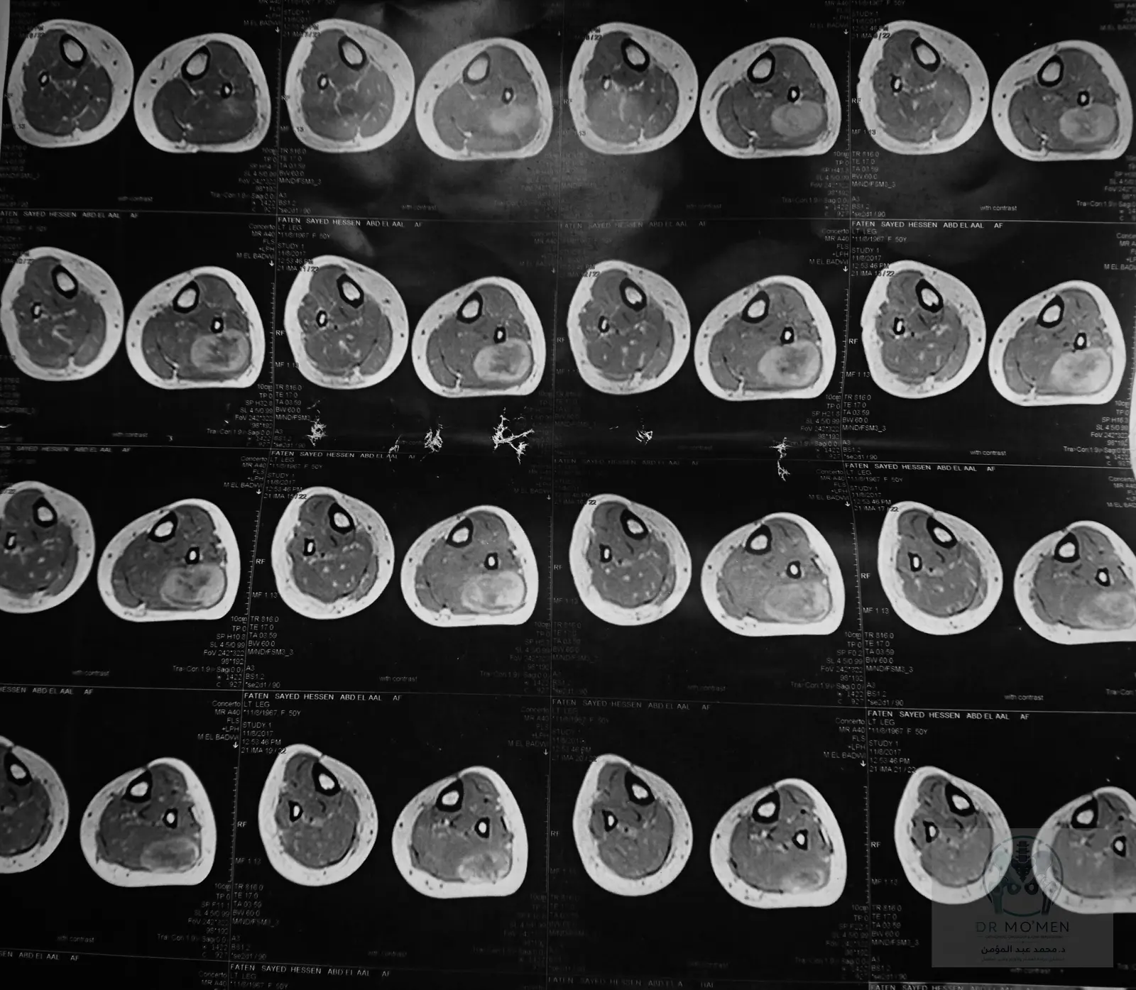 Axial MRI view showing proximity to the neurovascular plane.